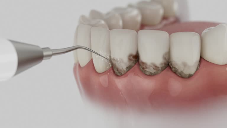 Trusted Wisdom Tooth Removal service in Algona, WA - Dentist Open Now